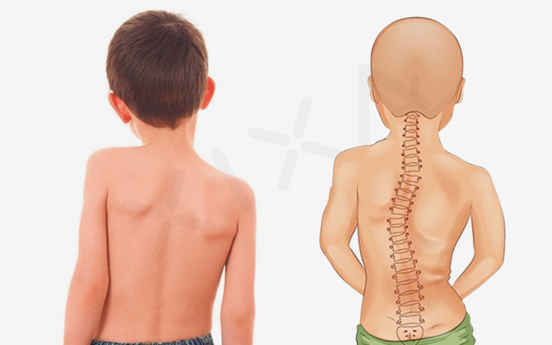 Cột sống trẻ bị cong vẹo do tư thế sai kéo dài