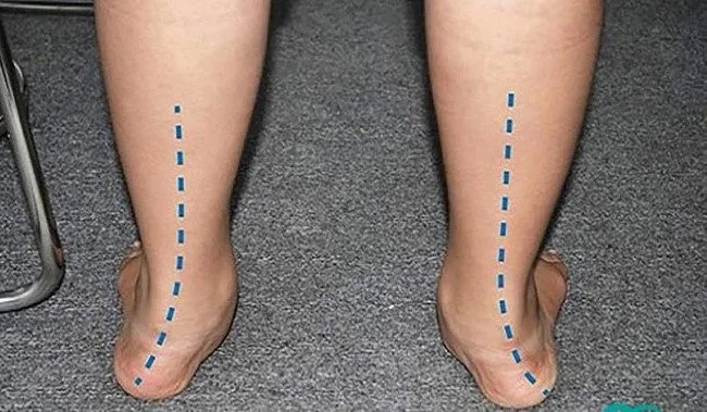 Trục chân lệch vào trong do bàn chân bẹt